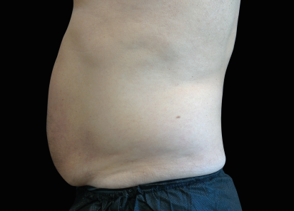 Bölgesel zayıflama emsculpt sonrası