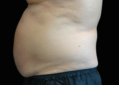 Bölgesel zayıflama emsculpt öncesi